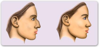 rhinoplastie tunisie
