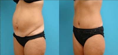 Chirurgie reparatrice ventre Tunisie