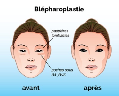 blepharoplastie tunisie