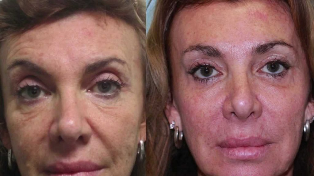 blephraoplastie avant apres