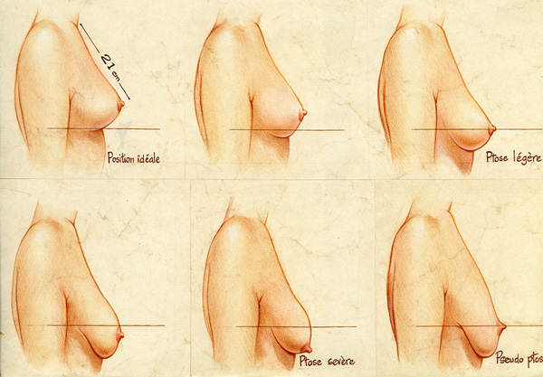 lifting-seins-tunisie