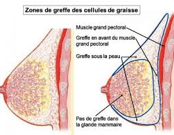 Zones de greffes des cellules de graisse Tunisie 