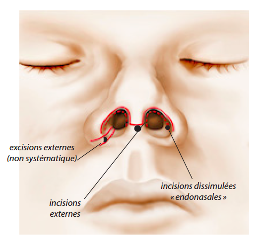 rhinoplastie tunisie