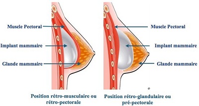 protheses mammaires tunisie