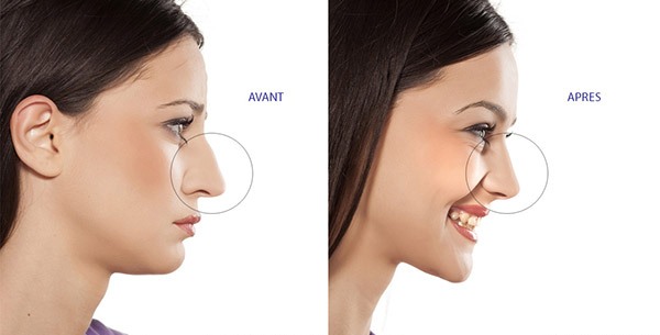 chirurgie-plastique-nez