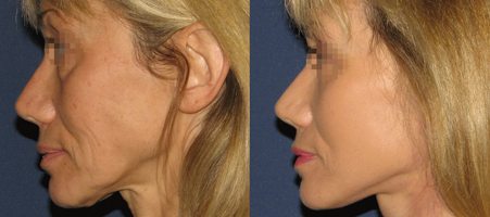 lifting cervico facial avant apres en Tunisie