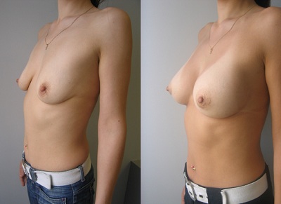 ptose mammaire avec implant