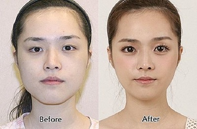 chirurgie esthetique en coree du sud 