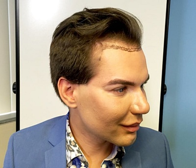 Rodrigo Alves 400 000 chirurgie esthetique