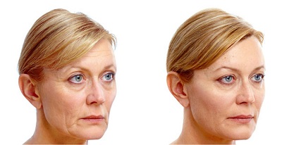 lifting et lipofilling du visage