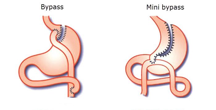 chirurgie obesite tunisie