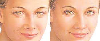 Blépharoplastie
