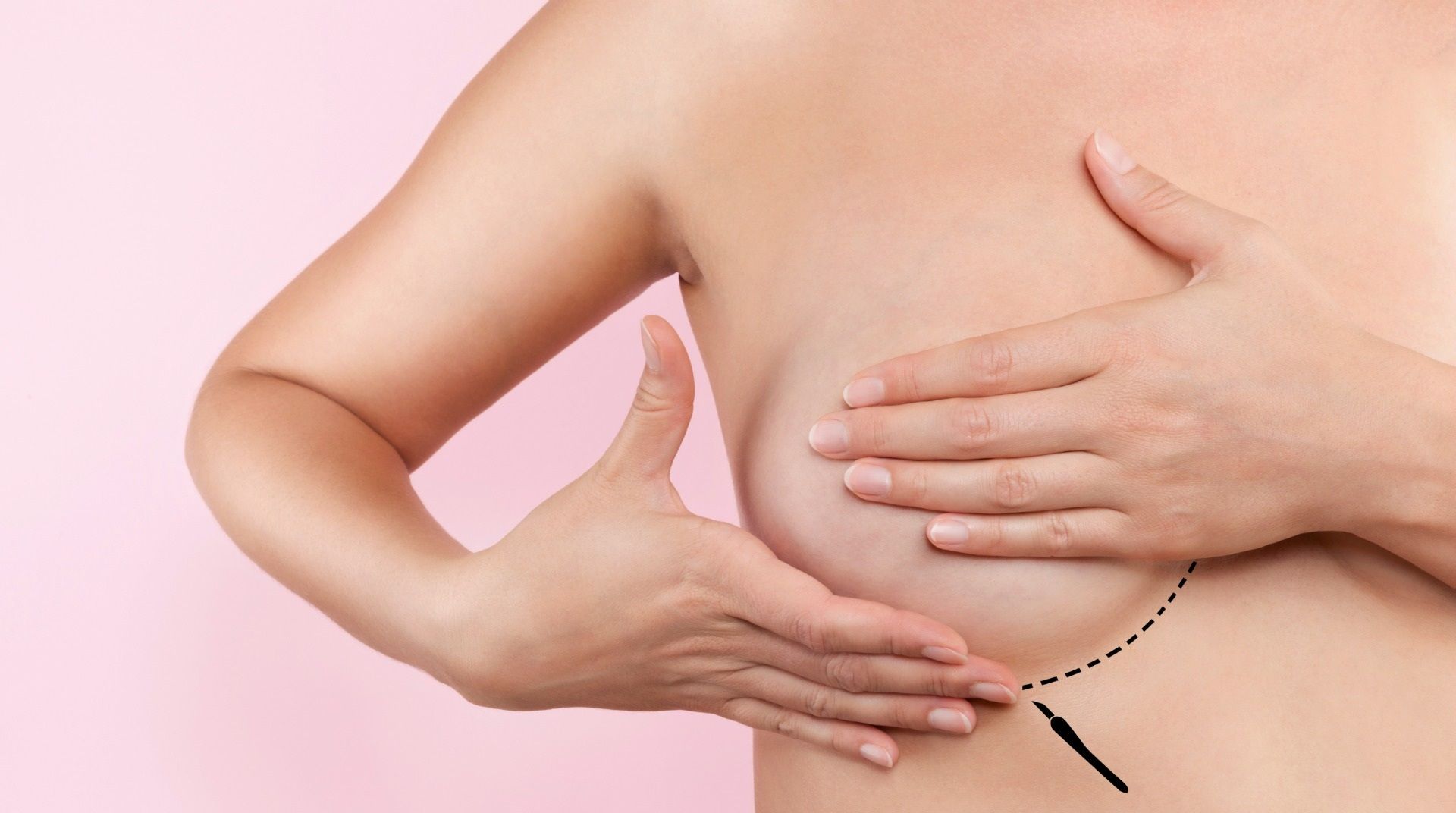Cicatrice lipofilling mammaire