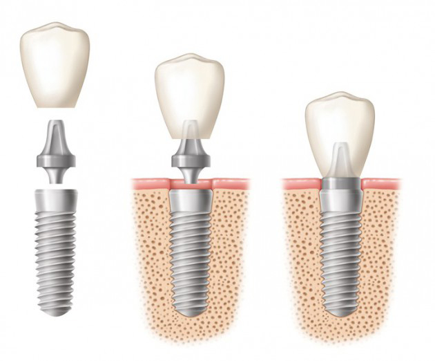 etapes pose implant dentaire