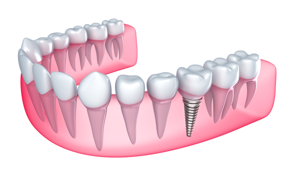 implant dentaire tunisie