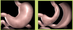avantages de sleeve gastrique
