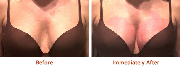 lifting-seins-vampire