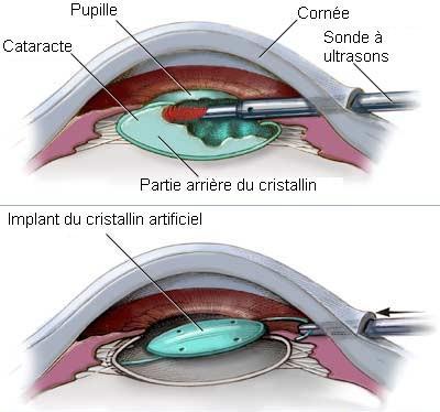 operation-cataracte-tunisie