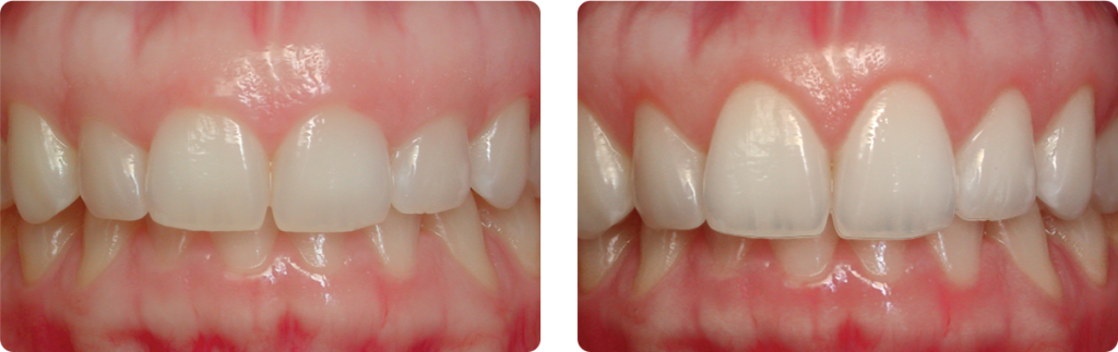 gingivectomie-tunisie