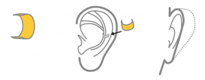 earfold chirurgie oreilles