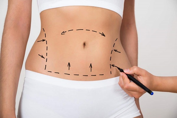 lipoaspiration en Tunisie