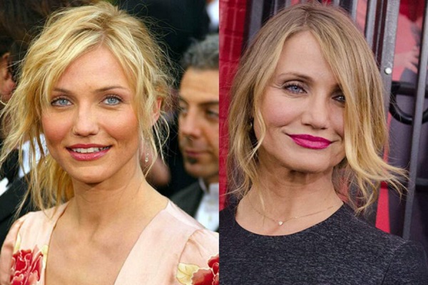 Cameron Diaz médecine esthétique