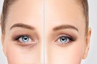 blépharoplastie Tunisie