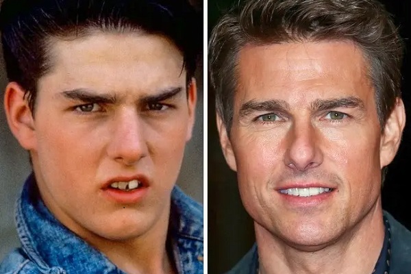Tom Cruise chirurgie dentaire