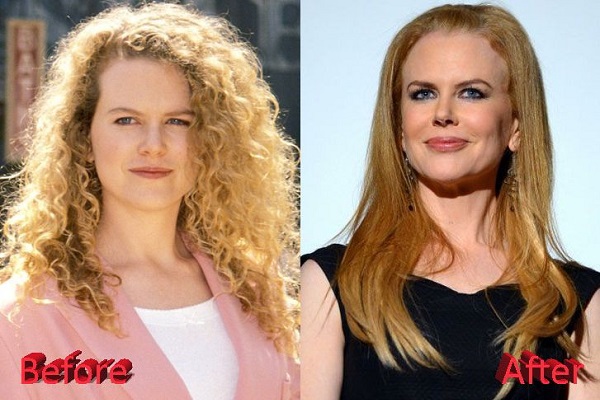 Nicole Kidman chirurgie esthétique