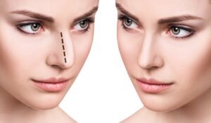 Les types de rhinoplasties