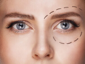 chirurgie esthétique des paupières
